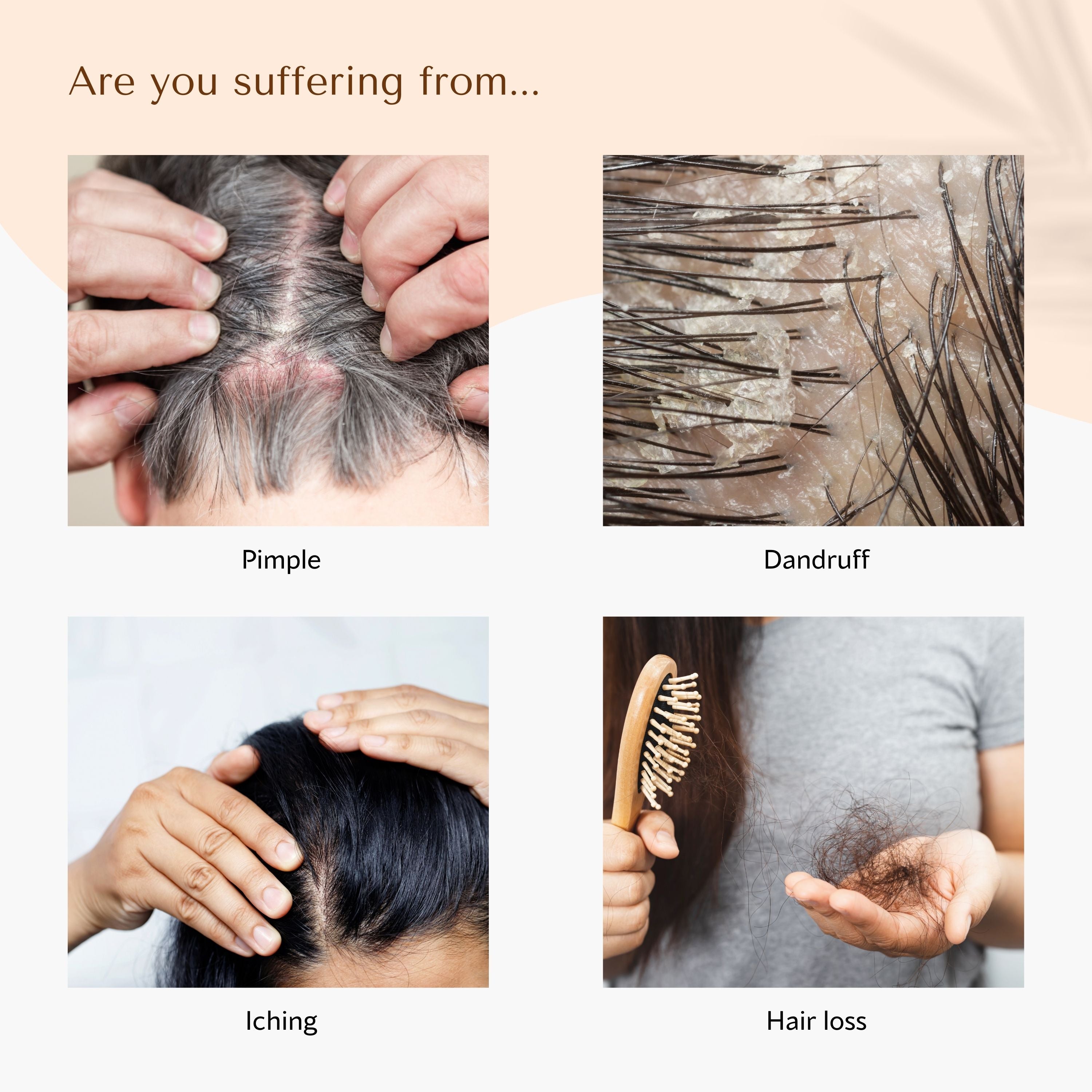Seborrheic shampoo that improves dandruff, itchiness, and pimples, WithBecon leanonme Shampoo, best shampoo for hair loss, best shampoo for hair loss female, anti hair loss shampoo, dermatologist recommended shampoo for hair loss, hair loss shampoo for men, good shampoo for hair loss, best shampoo for hair loss men, best shampoo and conditioner for hair loss, shampoo to prevent hair loss, shampoo to help with hair loss, mild shampoo for hair loss, organic shampoo for hair loss