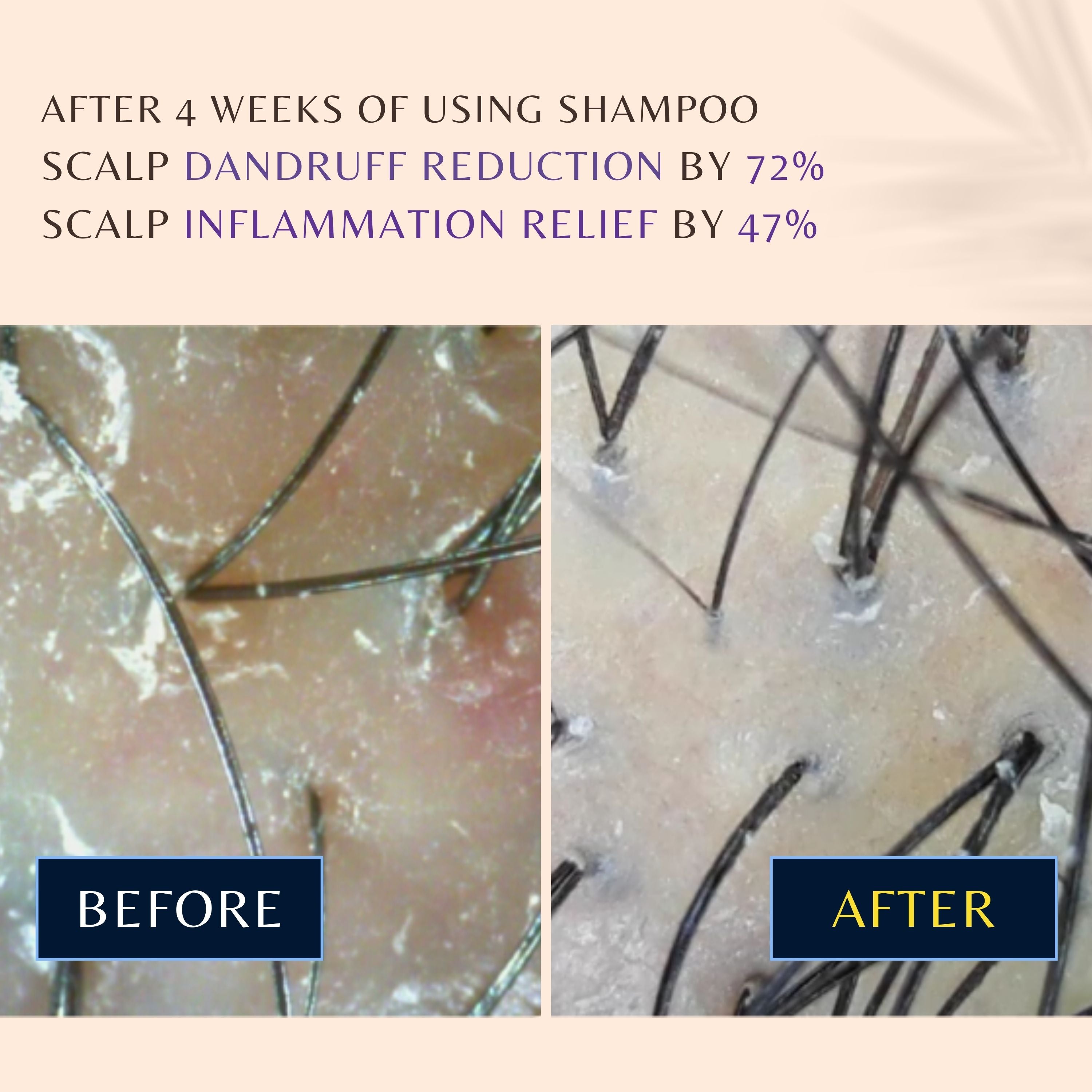 Seborrheic shampoo that improves dandruff, itchiness, and pimples, WithBecon leanonme Shampoo, best shampoo for hair loss, best shampoo for hair loss female, anti hair loss shampoo, dermatologist recommended shampoo for hair loss, hair loss shampoo for men, good shampoo for hair loss, best shampoo for hair loss men, best shampoo and conditioner for hair loss, shampoo to prevent hair loss, shampoo to help with hair loss, mild shampoo for hair loss, organic shampoo for hair loss