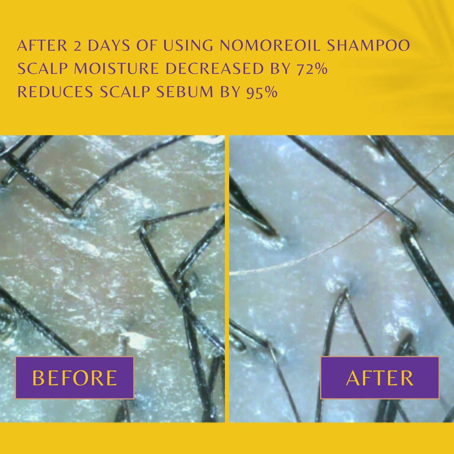 WithBecon no more oil Shampoo, best shampoo for hair loss, best shampoo for hair loss female, anti hair loss shampoo, dermatologist recommended shampoo for hair loss, hair loss shampoo for men, good shampoo for hair loss, best shampoo for hair loss men, best shampoo and conditioner for hair loss, shampoo to prevent hair loss, shampoo to help with hair loss, mild shampoo for hair loss, organic shampoo for hair loss