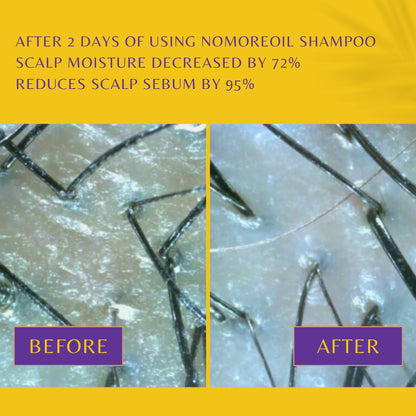 WithBecon no more oil Shampoo, best shampoo for hair loss, best shampoo for hair loss female, anti hair loss shampoo, dermatologist recommended shampoo for hair loss, hair loss shampoo for men, good shampoo for hair loss, best shampoo for hair loss men, best shampoo and conditioner for hair loss, shampoo to prevent hair loss, shampoo to help with hair loss, mild shampoo for hair loss, organic shampoo for hair loss